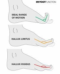 Hallux Rigidus: How Your Big Toe Affects All Movement - MOTIVNY NYC Physical Therapy & Training